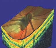 glaucomadisk