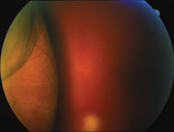 choroidal detachment