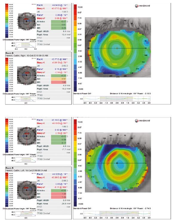 Orthokeratology: Principles, Lessons, Cases