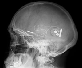 implant 2