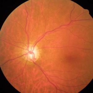 New implant could help glaucoma treatment