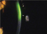 FLN-Fig-1-C-corneal-oedema.jpg