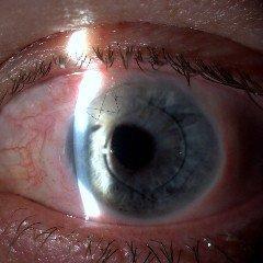 Corneal graft