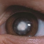 Child congenital cataract