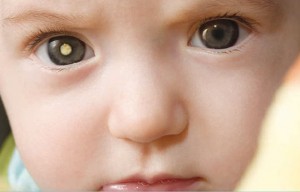 retinoblastoma_web