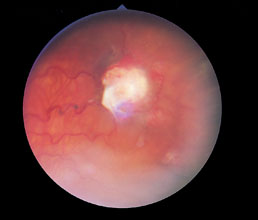 Channel 5 Retinal 