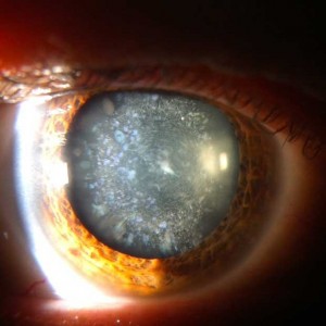 Cataract