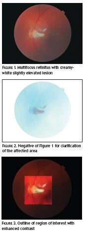 candidiasis