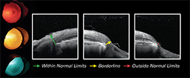 SPECTRALIS GLAUCOMA SIGNALS