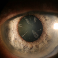 cataract