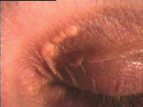 xanthelasmata