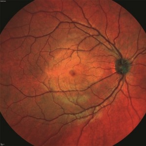 Widefield-Fundus-Module_and-OCT-from-Heidelberg-300x300