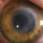keratitis