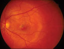 choroidal haemangioma