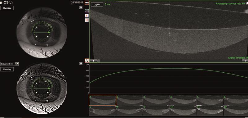 Bilateral Spontaneous Anterior Dislocation Of Intraocular Lens With The Capsular  Bag In A Patient With Pseudoexfoliation | PPT