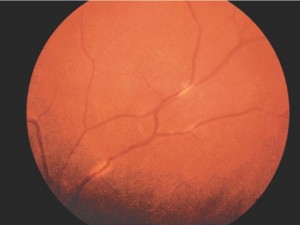 Vascular Disease