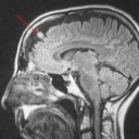 Small dense lesion