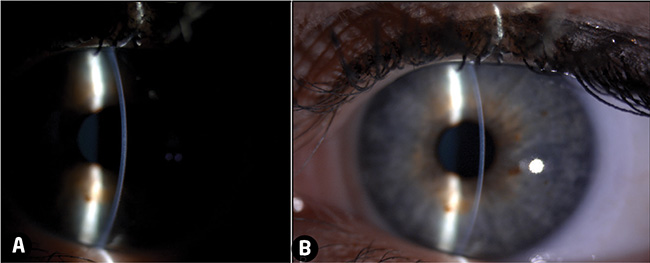 slit lamp