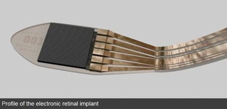 implant