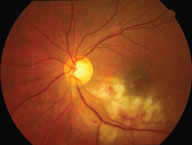 cmv retinitis