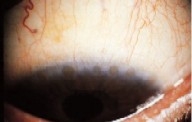 Herbet pits in trachoma. Courtesy of J Kanski